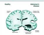 Xét nghiệm máu có thể phát hiện bệnh Alzheimer ở giai đoạn sớm