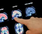 Trí tuệ nhân tạo giúp phát hiện sớm bệnh Alzheimer