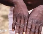 Ban bố tình trạng khẩn cấp về sức khỏe cộng đồng tại Congo