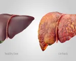Loại thực phẩm giúp ngăn ngừa và đảo ngược tình trạng gan nhiễm mỡ
