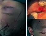 Nghệ An: Cấp cứu trẻ bị chó cắn tổn thương nghiêm trọng vùng mặt