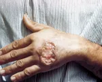Thái Lan cảnh báo bệnh nhiễm ký sinh trùng Leishmania gây tử vong