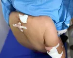 Cụ bà 77 tuổi bị đàn chó cắn, nhiều vết thương khắp cơ thể