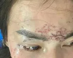 Khởi tố vụ án người phụ nữ bị tạt axit, xăm lên mặt do ghen tuông