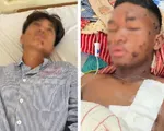 Nổ mìn tự chế khi đi đánh cá, hai thiếu niên bị thương nặng