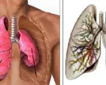 Bệnh phổi tắc nghẽn mãn tính: Dấu hiệu và cách điều trị