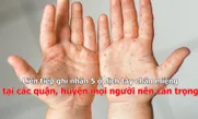Liên tiếp ghi nhận 5 ổ dịch tay chân miệng tại các quận, huyện mọi người nên cẩn trọng