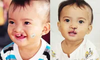 Children receive free cleft lip and palate surgery