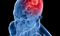 New brain tumor treatment