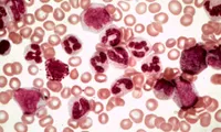 Stem cell Leukaemia treatment