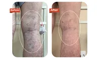 Foreign Tourist Recovers After Varicose Vein Treatment at Dr.Vein