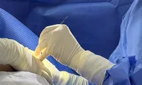 Causes of early breast implant rupture