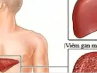 Khó tránh khỏi nhiễm bệnh viêm gan C khi xăm hình