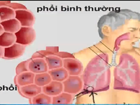 Phòng bệnh viêm phổi ở người cao tuổi