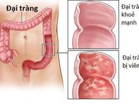 Viêm đại tràng - Căn bệnh âm ỉ có thể biến chứng thành ung thư