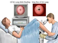 Dấu hiệu sớm của bệnh ung thư cổ tử cung