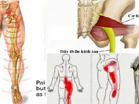 Các biện pháp chữa đau lưng, đau thần kinh tọa do thoát vị đĩa đệm