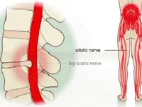 Phát hiện sớm và điều trị bệnh đau lưng, đau thần kinh tọa