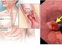 Yếu tố nào có nguy cơ gây ung thư thực quản?