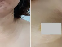 Ứng dụng thành công phẫu thuật nội soi điều trị u tuyến giáp