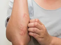 Các loại bệnh có thể lây nhiễm từ hồ bơi