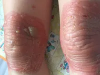 Bỏng đầu gối do bó thuốc nam trị đau khớp