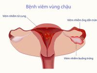 Bùng nổ căn bệnh lây lan qua đường tình dục khiến phụ nữ vô sinh