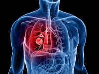 Gia tăng số ca mắc ung thư phổi tại Việt Nam