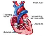 Những điều cần biết về bệnh tim bẩm sinh Tứ chứng Fallot