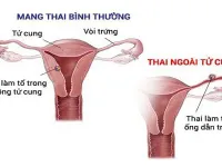 Phẫu thuật kịp thời một ca chửa kẽ hy hữu