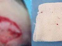 Loét giác mạc, mắt nhìn mờ vì biến chứng nhấn mí tại spa