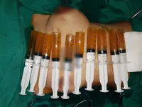 Ngực to như quả bóng, chực 'phát nổ' sau khi đặt túi ngực