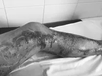 Cứu hai vợ chồng bị sét đánh khi đang làm đồng