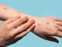 Virus đậu mùa khỉ lây truyền 4 ngày trước khi các triệu chứng bệnh xuất hiện