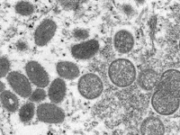 Cảnh báo virus đậu mùa khỉ có thể đã âm thầm lây lan