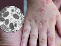 WHO báo cáo thêm 2 ca tử vong do đậu mùa khỉ, bệnh dịch lây lan sang các khu vực mới
