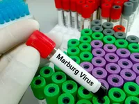 Bùng phát virus Marburg gây tử vong cao ở Tanzania