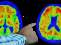 Thêm loại thuốc hứa hẹn làm chậm quá trình Alzheimer