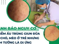 Cảnh báo nguy cơ nhiễm ấu trùng giun đũa từ chó, mèo ở trẻ