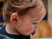 Dịch sởi b&ugrave;ng ph&aacute;t ở trẻ em tại Anh