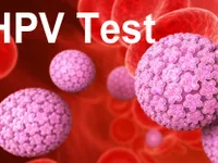 Bộ dụng cụ tự sàng lọc giúp phụ nữ Thái Lan tự xét nghiệm HPV