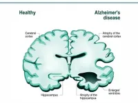 Xét nghiệm máu có thể phát hiện bệnh Alzheimer ở giai đoạn sớm