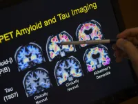 Phương pháp xét nghiệm máu giúp chẩn đoán bệnh Alzheimer nhanh và chính xác hơn