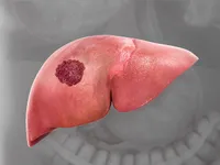 Phát hiện hợp chất tự nhiên có khả năng ức chế sự phát triển của ung thư gan