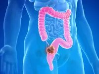 Phát hiện yếu tố làm tăng nguy cơ ung thư đại tràng ở người trẻ