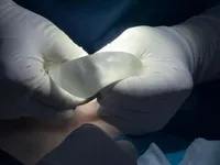 Recurrent Breast Ptosis: Signs, Challenges, and Treatment