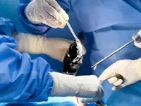 Breast Augmentation Complications: Capsular Contracture, Implant Rupture, Infection