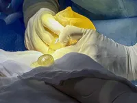 What Is Breast Implant Rupture?