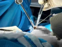 What is recurrent capsular contracture?