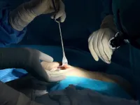 Breast firmness after augmentation: Signs, causes, and treatment